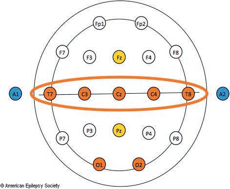 The 10-20 System electrode placements modified for neonates