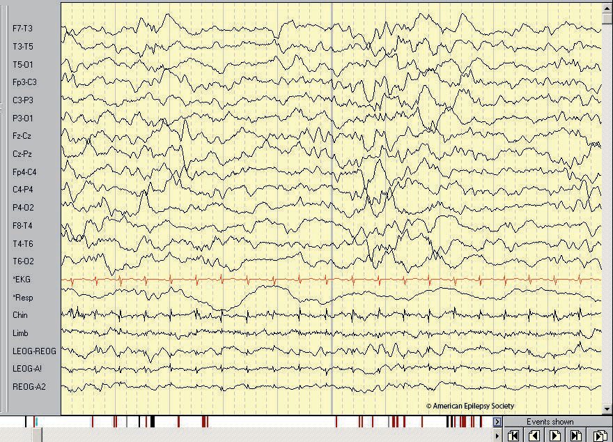 Typical neonatal montage