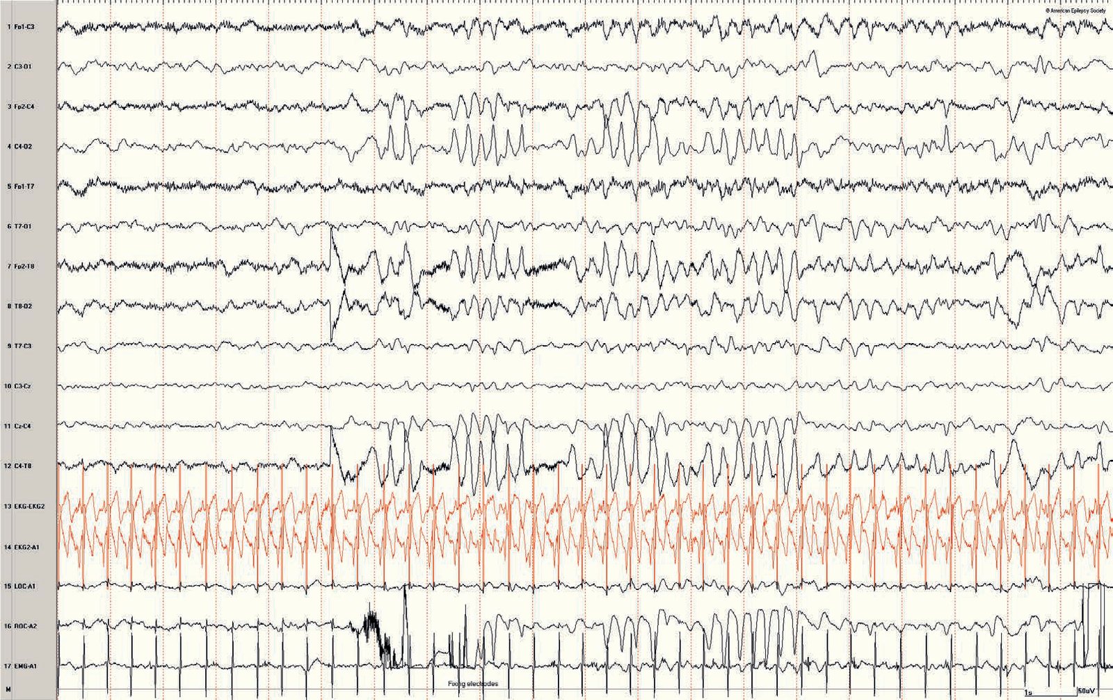 Neonatal EEG artifacts from technician fixing electrodes