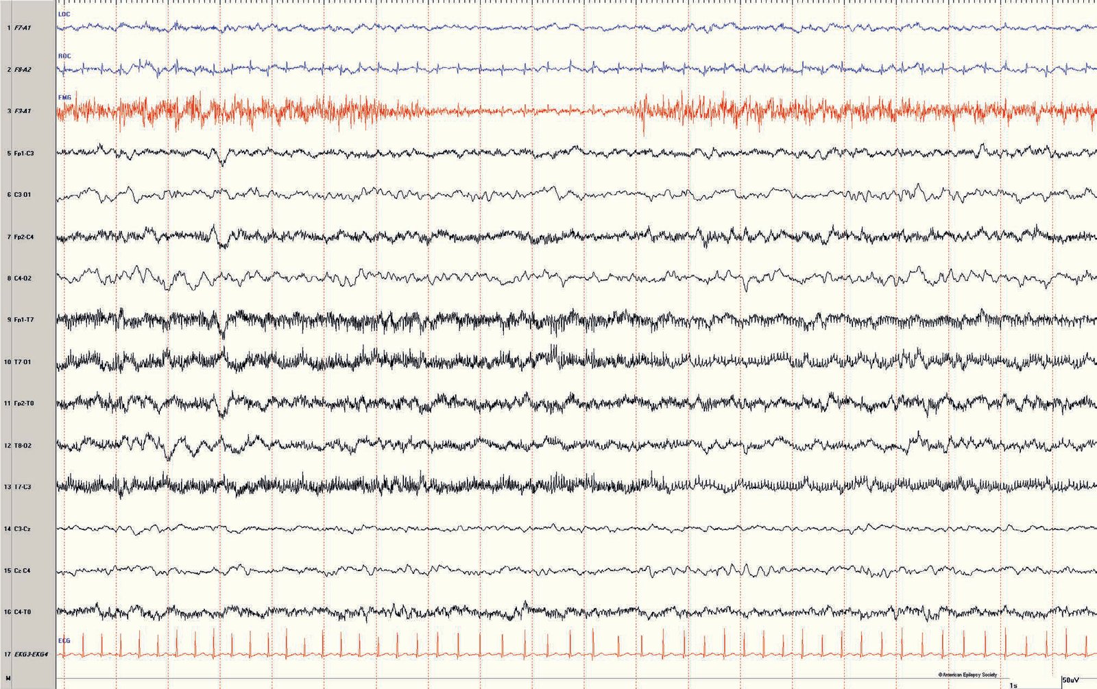 Continuous neonatal EEG. Continuity in neonatal EEG refers to a trace with a steady amplitude
