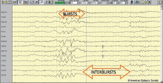 Discontinuous neonatal EEG. Discontinuity in neonatal EEG refers to periods of relatively higher amplitude or bursts tha