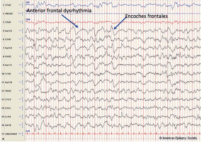 Neonatal EEG synchrony: example of encoches frontales and anterior frontal dysrhythmia