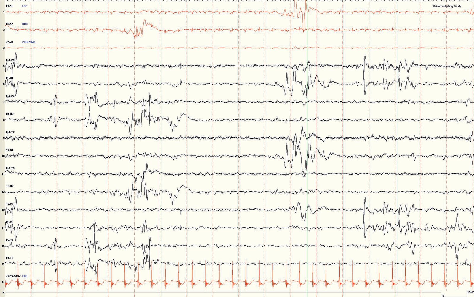 Neonatal EEG: asynchrony
