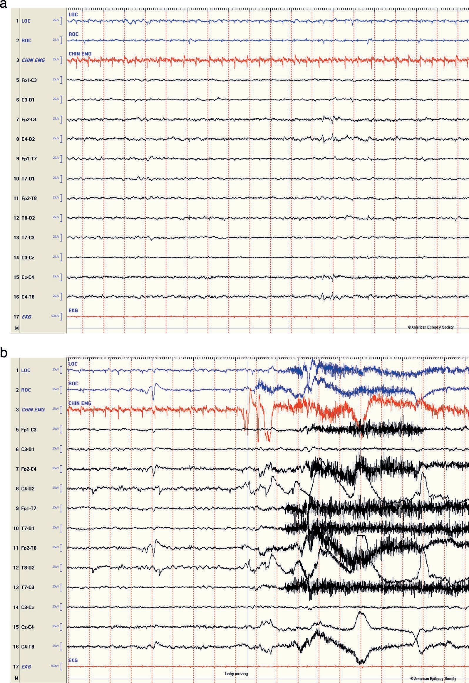 Low-amplitude neonatal EEG in hypoxic-ischemic encephalopathy