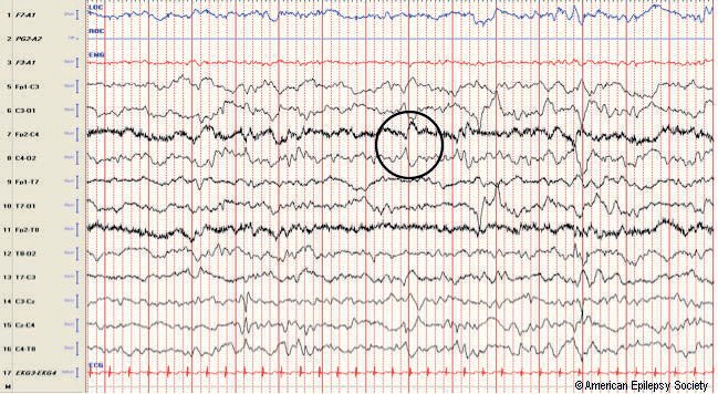 Normal sharp transients, central region
