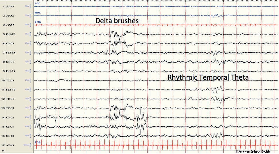 Central delta brushes, right rhythmic temporal theta