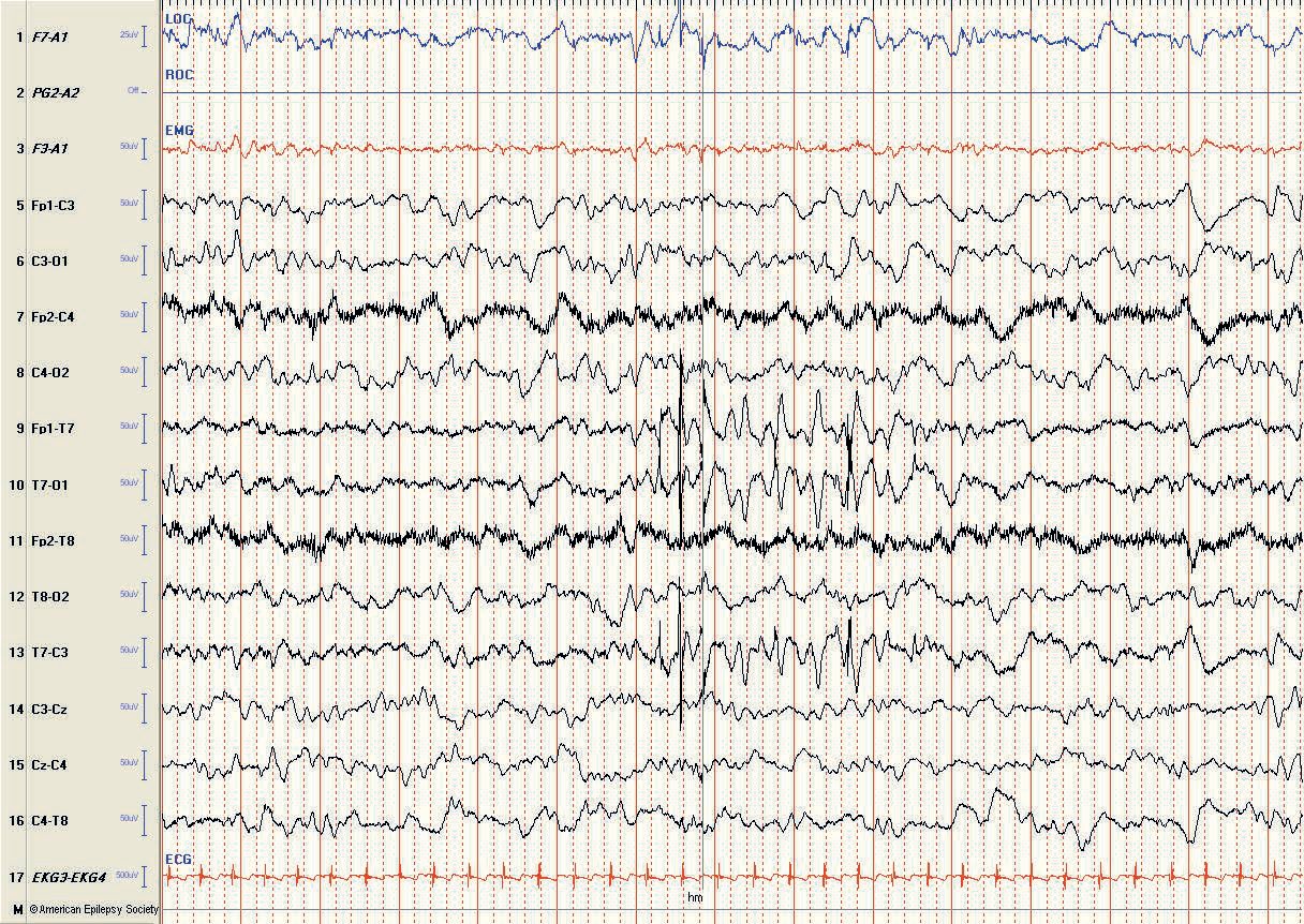 Neonatal EEG: artifact