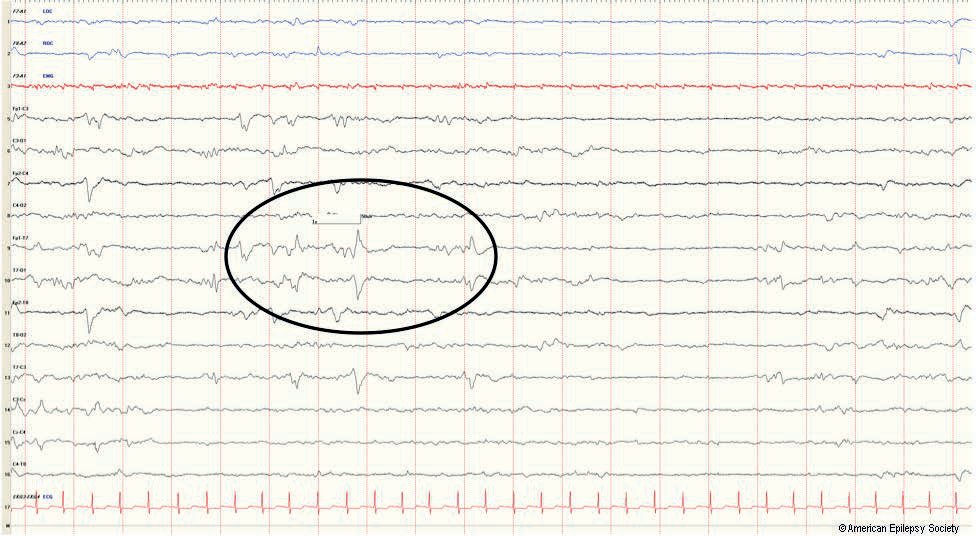 Positive temporal sharp wave