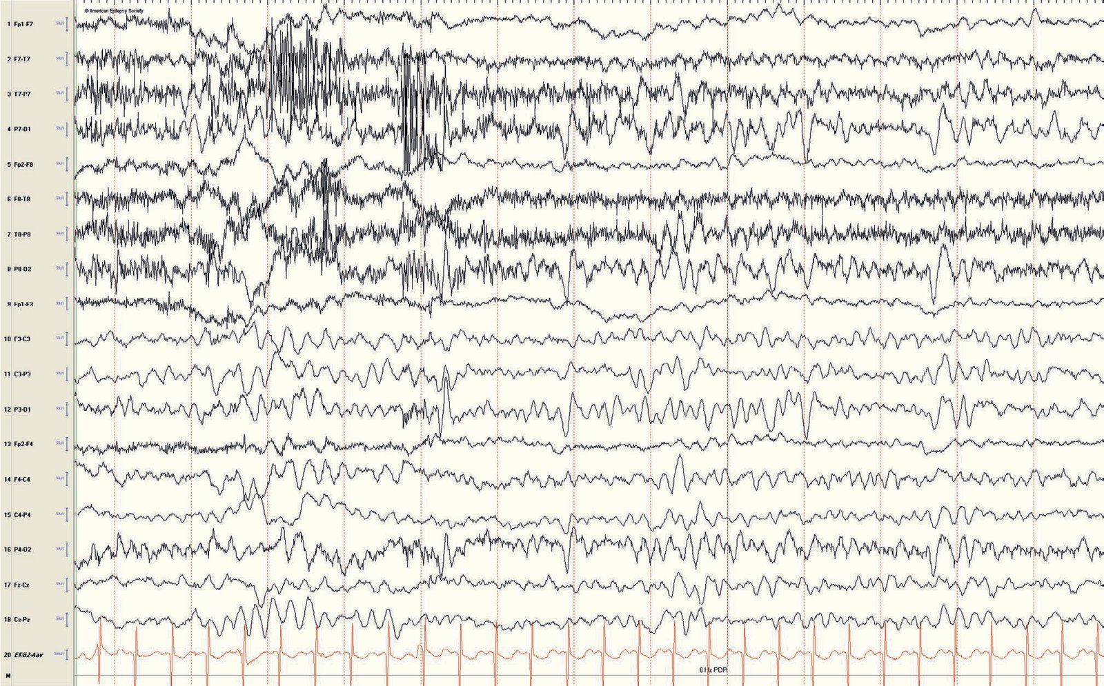 Pediatric EEG: 5- to 6-Hz PDR in an 11-month-old child