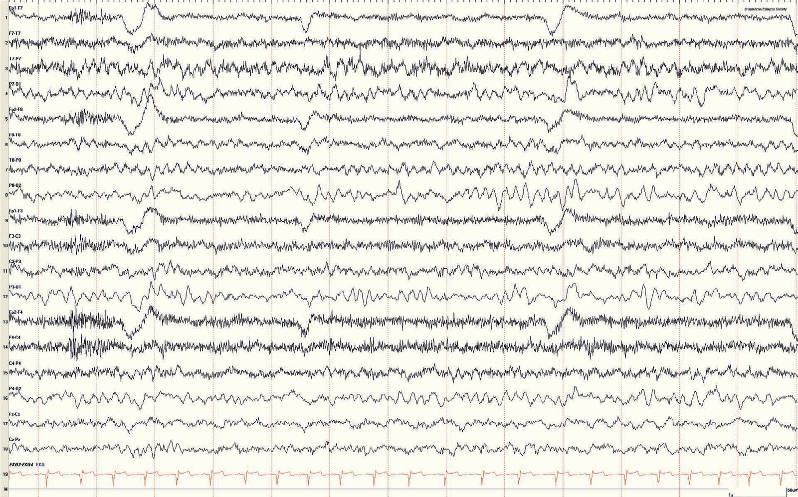 Pediatric EEG: 6- to 7-Hz PDR in a 12-month-old child