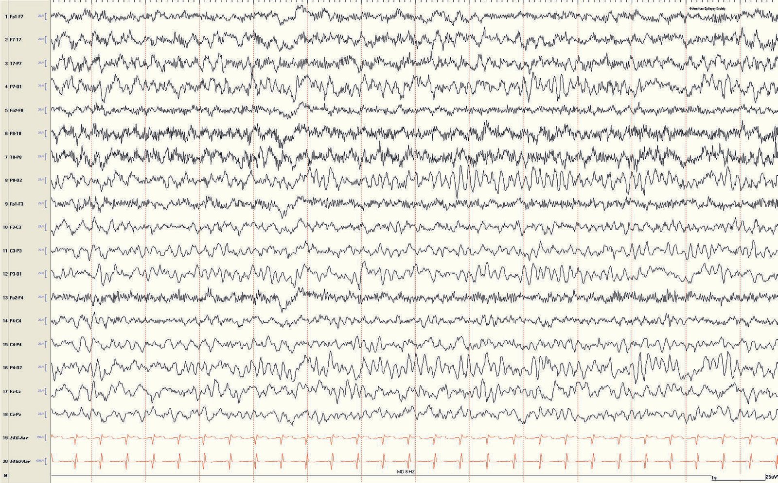 Pediatric EEG: normal 16-month-old waking EEG record, reaching 7- to 8-Hz PDR