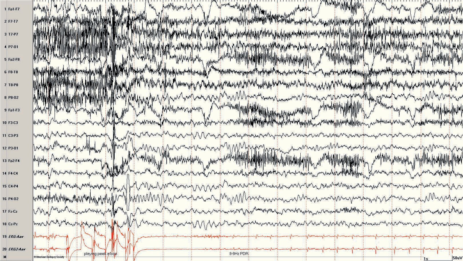 Pediatric EEG: eye closing in a 23-month-old boy playing “peek-a-boo,” demonstrating 7-Hz PDR