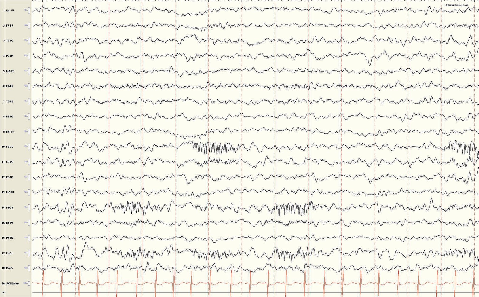 Pediatric EEG: asynchronous spindles in a 16-month-old boy