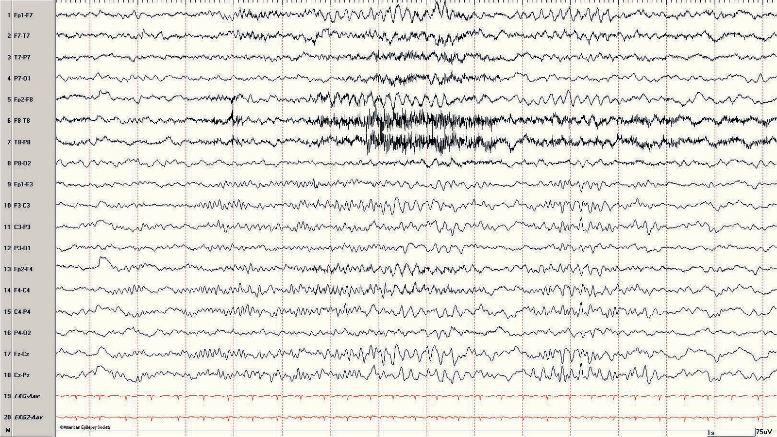 Frontal arousal in a 16-month-old boy