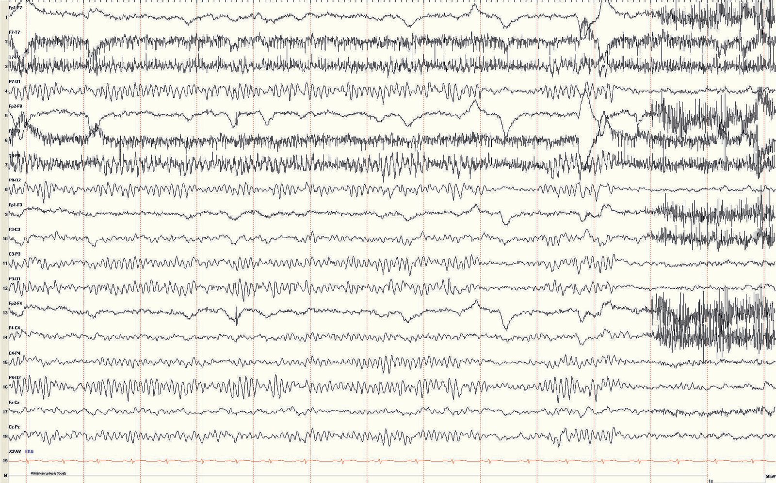Pediatric EEG: normal waking background in a 10-year-old girl, showing a 10-Hz alpha PDR