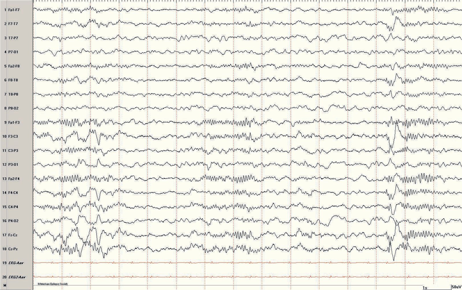 Pediatric EEG: N2 (stage 2 NREM) sleep in an 8-year-old boy