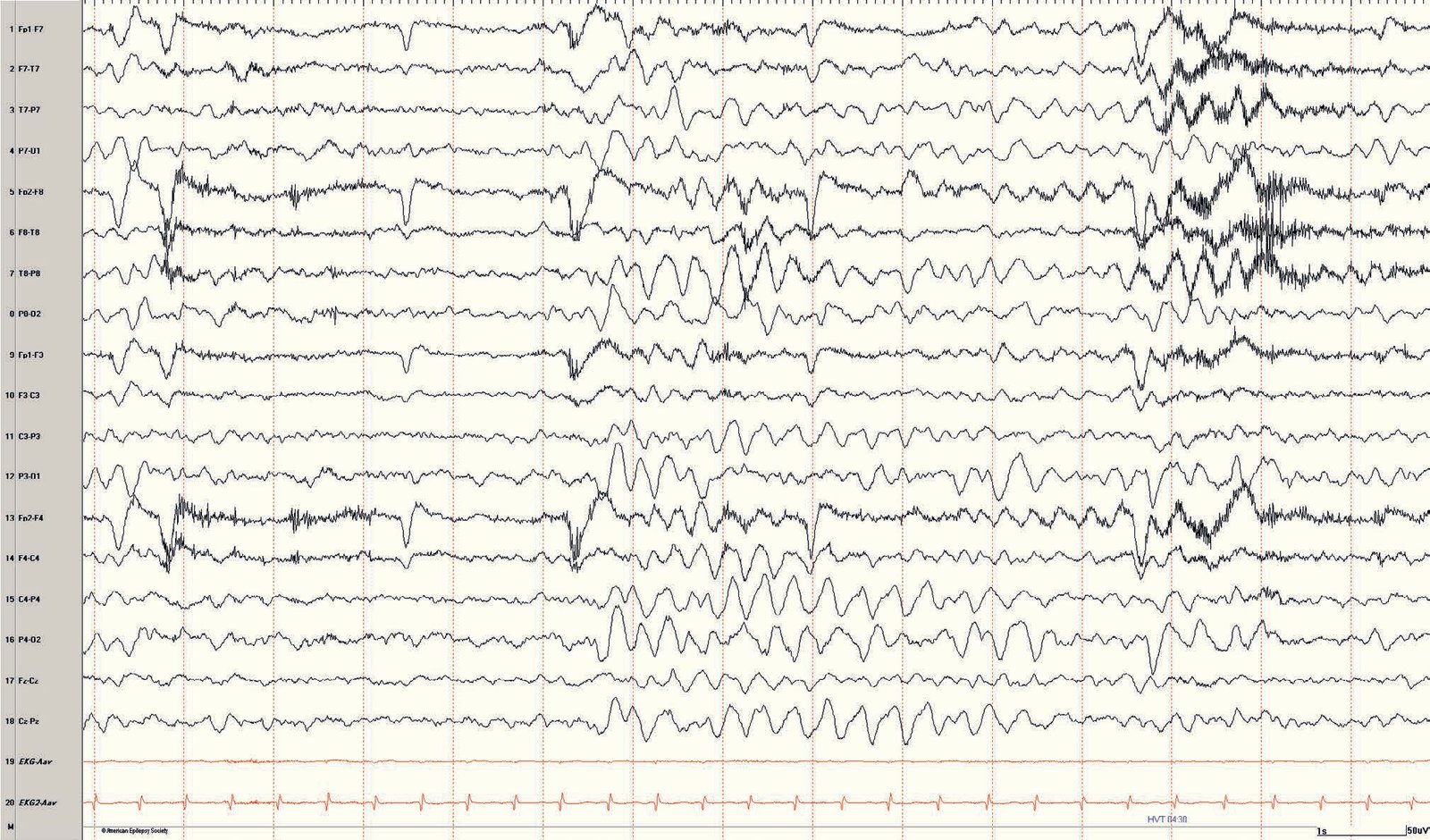 Pediatric EEG: buildup of slow wave frequencies during hyperventilation in a 7-year-old girl