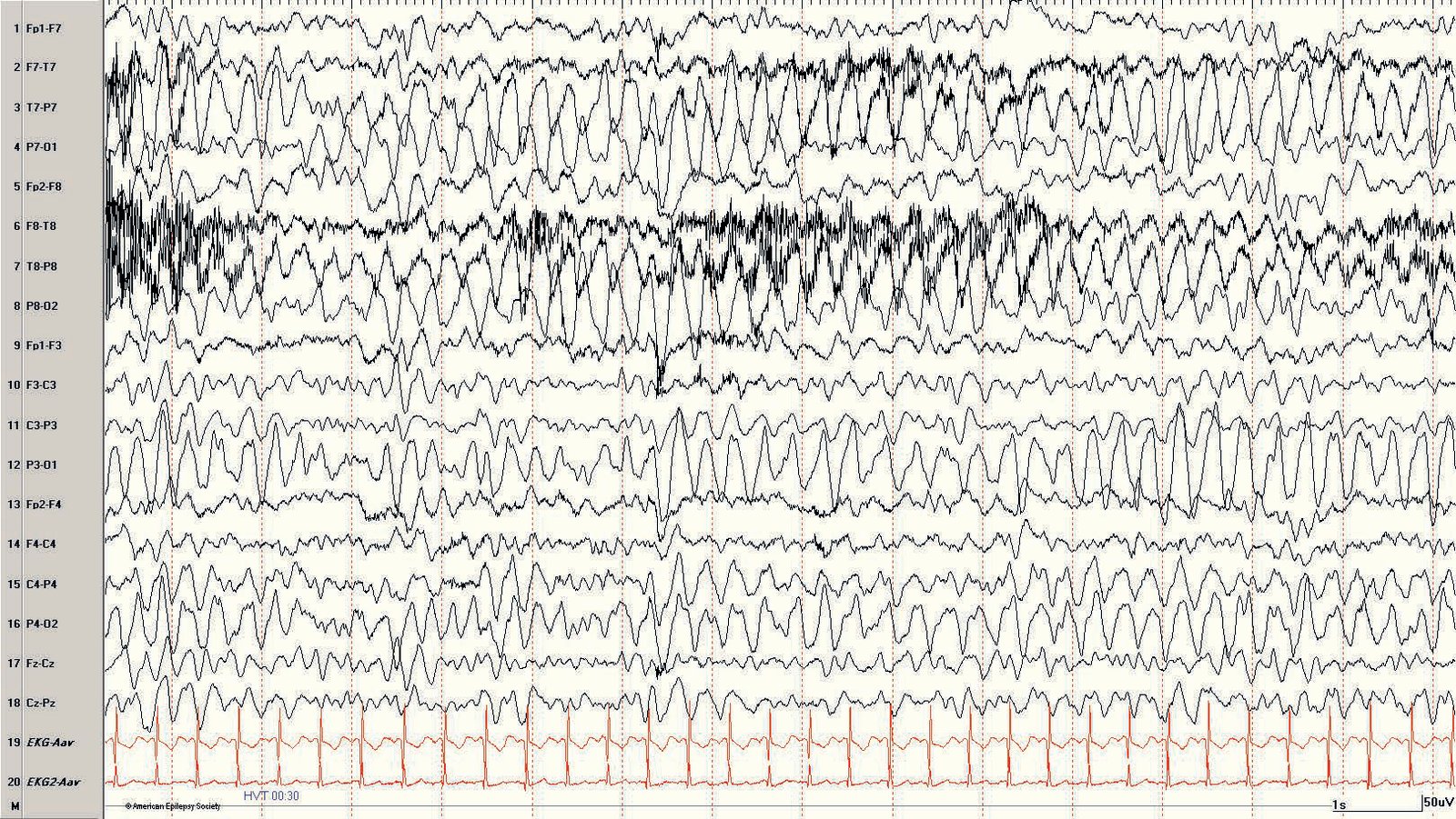 Pediatric EEG: build-up response becomes more prominent later during hyperventilation in the same 7-year-old girl as sho