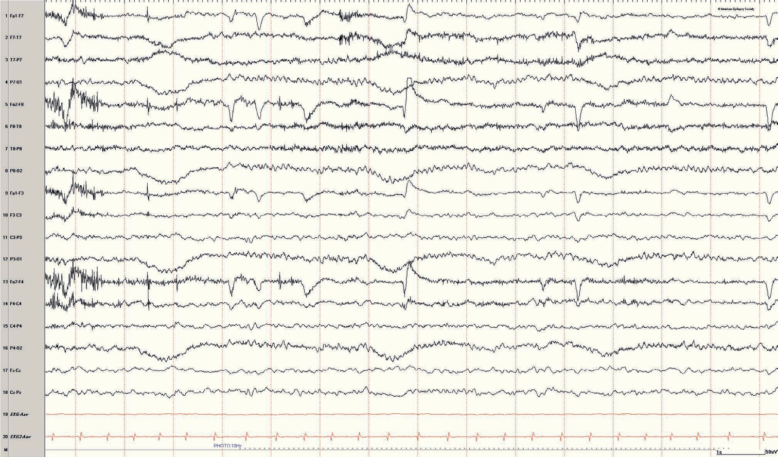 Pediatric EEG: photic driving response at 10-Hz flash frequency in a 7-year-old girl