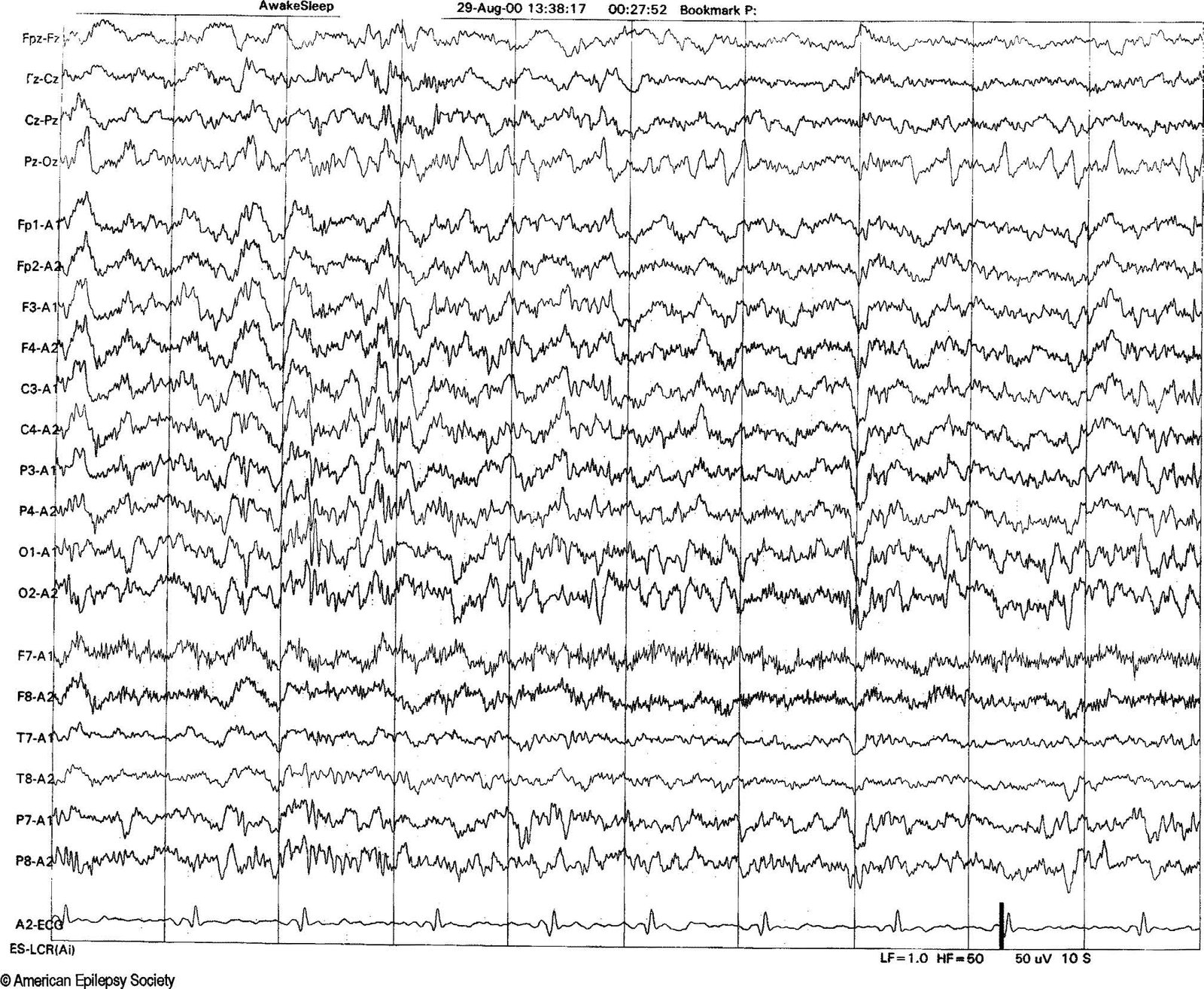 Example of 14- and 6-Hz positive spikes in a 13-year-old girl