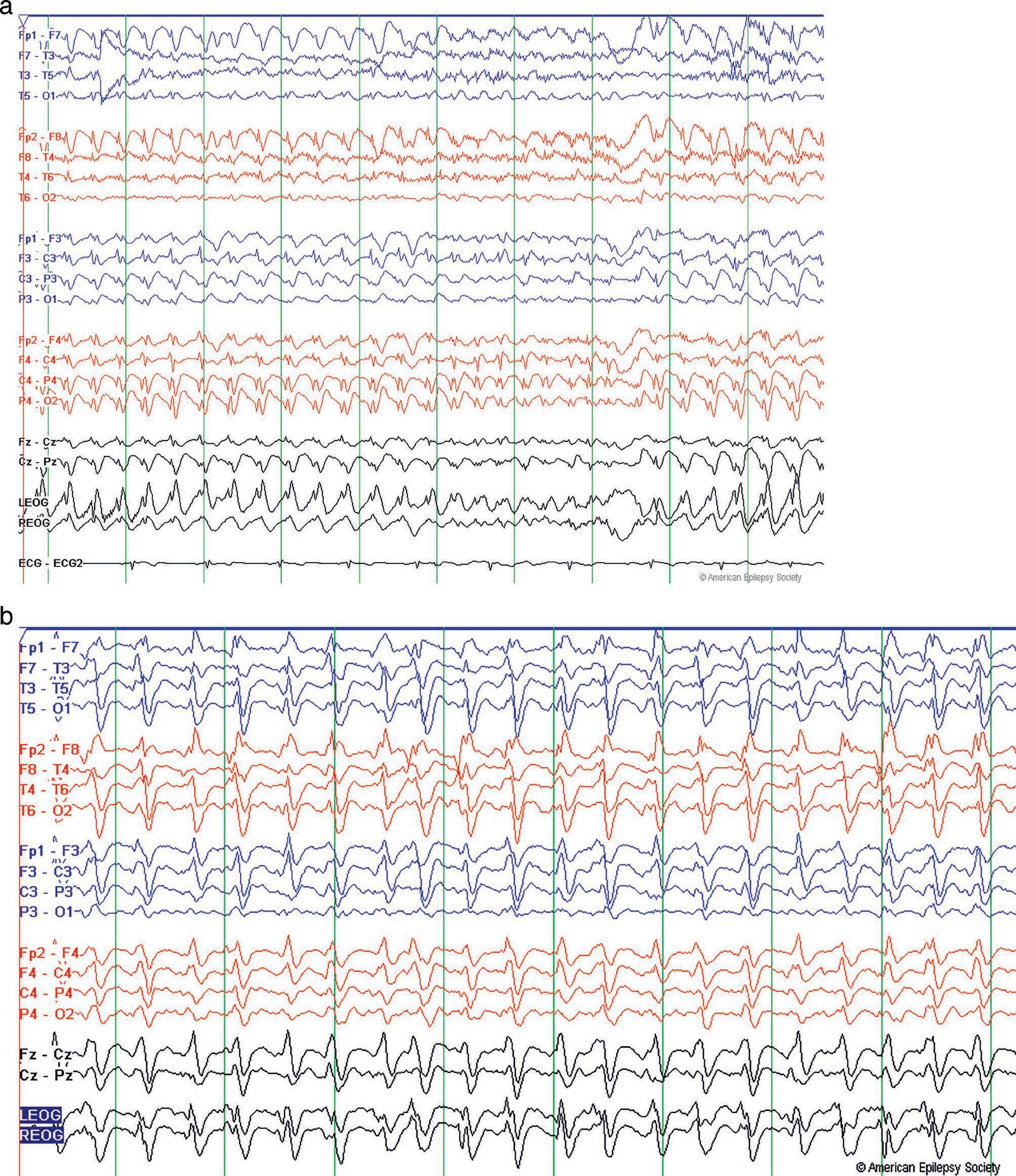 EEG examples of NCSE. The EEG in both (a) and (b) are displayed in a longitudinal bipolar display montage with a sensiti