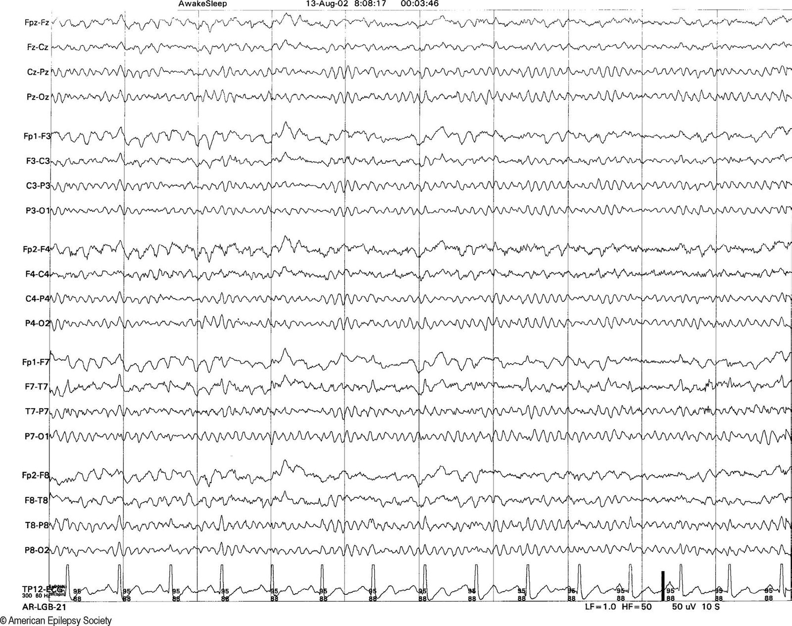 Eye flutter evident in the frontopolar and anterior leads