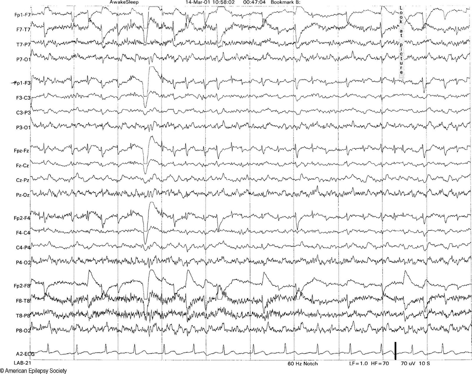 Rapid eye movements generate small spike-like discharges in the frontopolar derivations