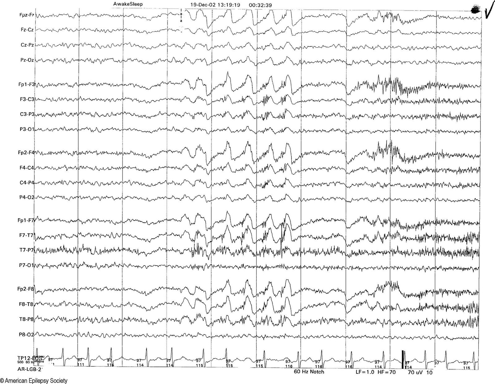 Glossokinetic potentials from tongue movement, reproducible by having the patient say “la, la.”