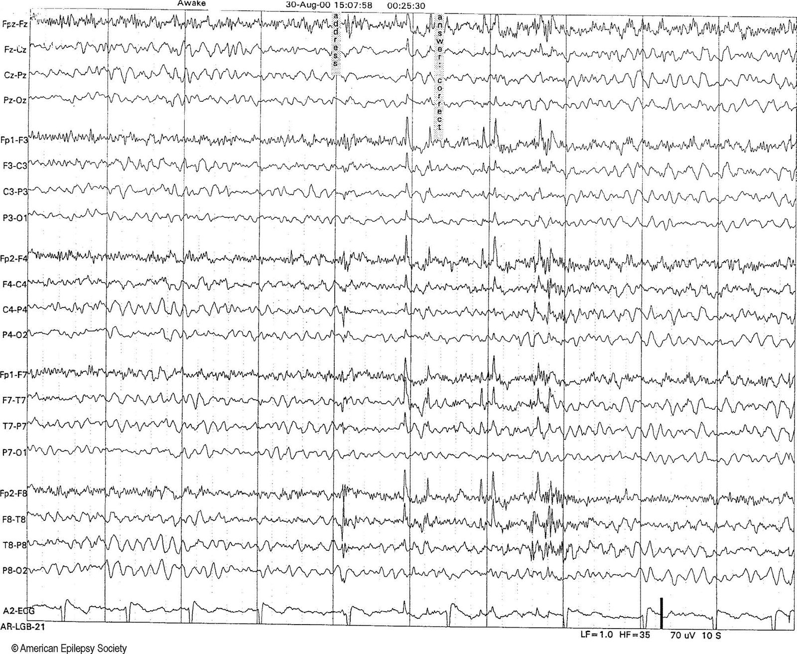 Dissimilar metals causing electrostatic artifacts during talking generate spiky waveforms in seconds 5 through 8 of this