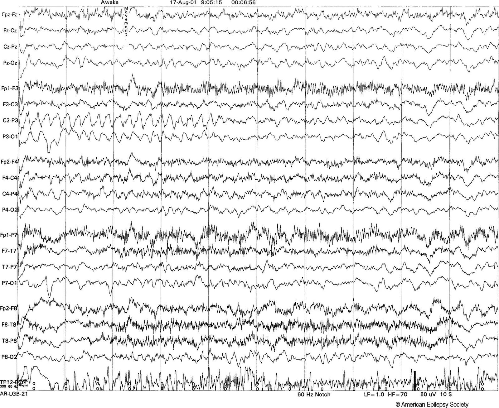 Movement artifact mimicking a partial seizure discharge at the P3 electrode