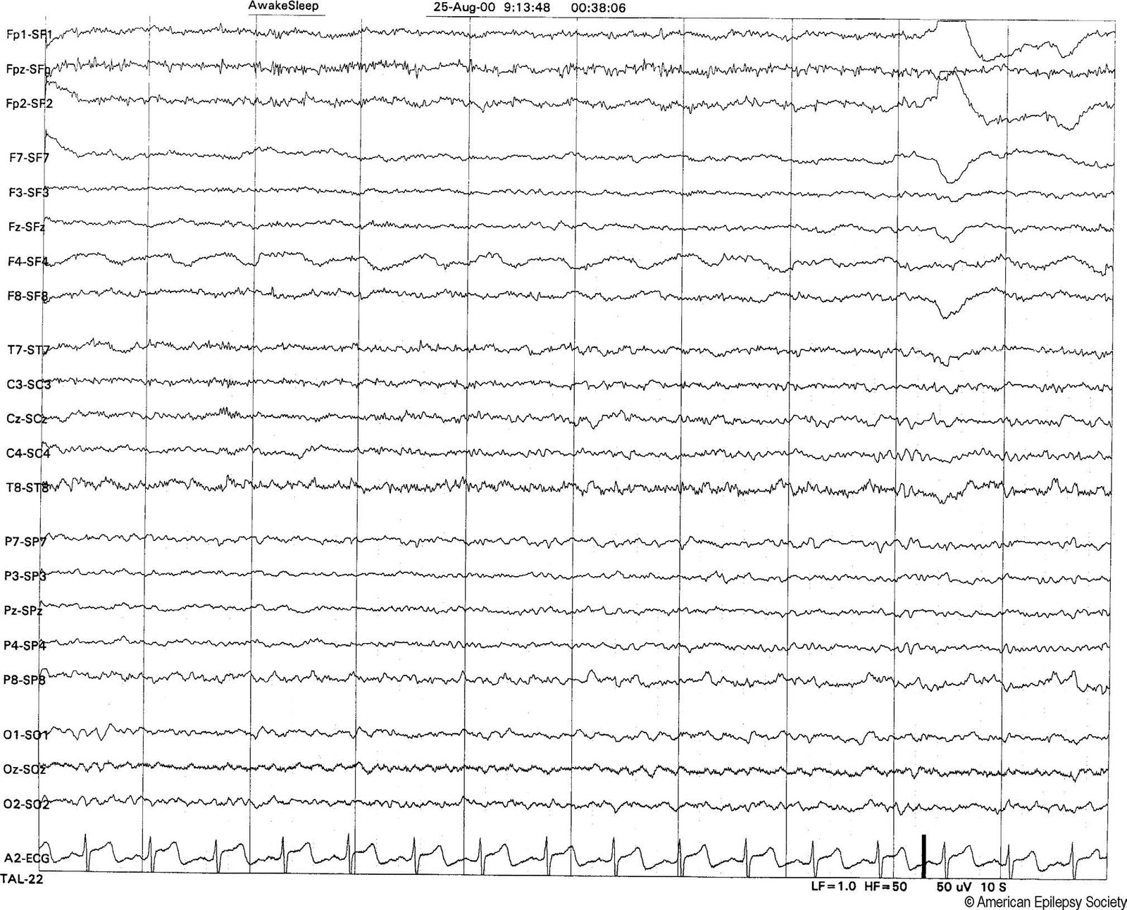Pulse artifact creates rhythmic slow wave artifact at F4