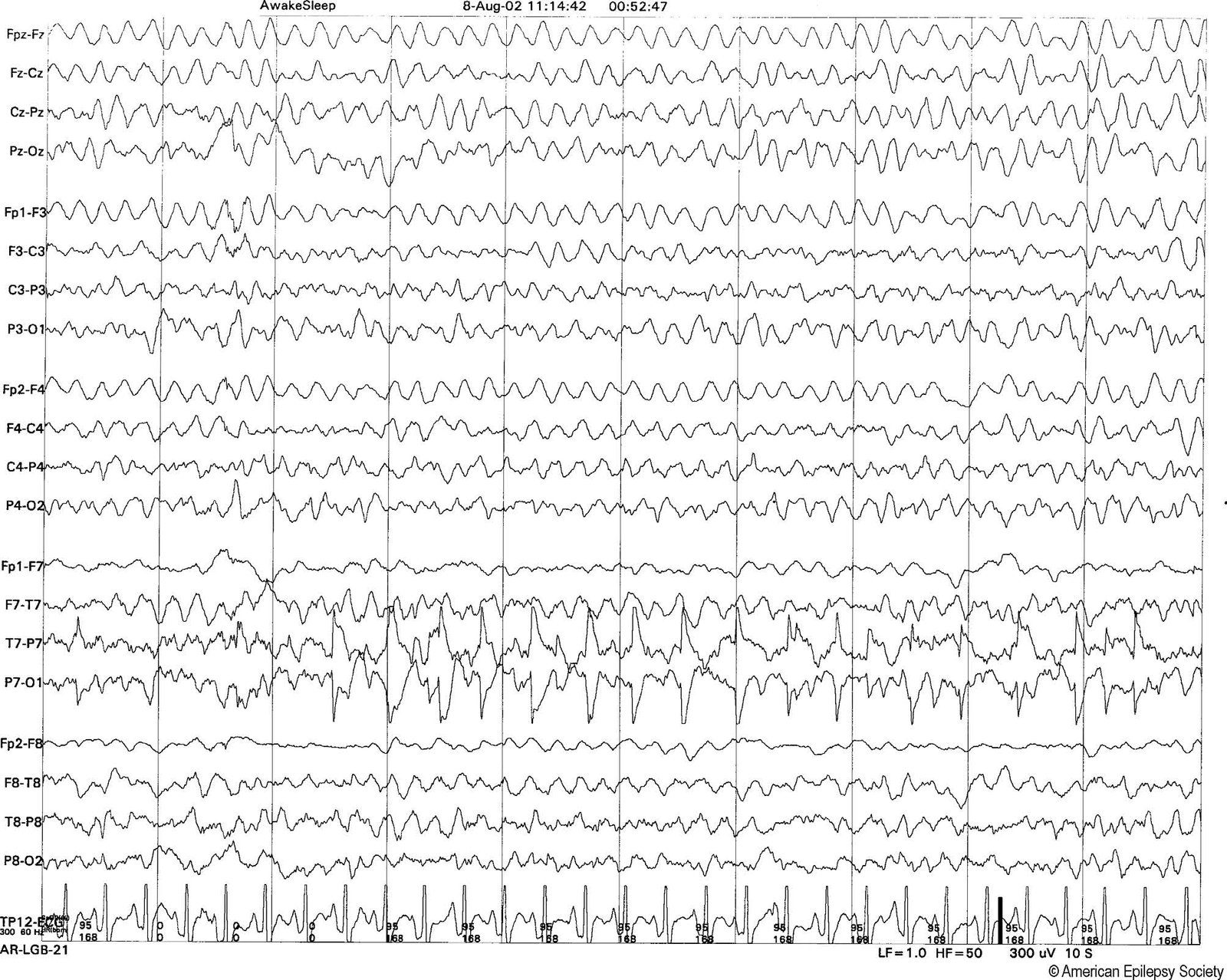 Electrode “pop” artifact at P7 simulates rhythmic seizure activity