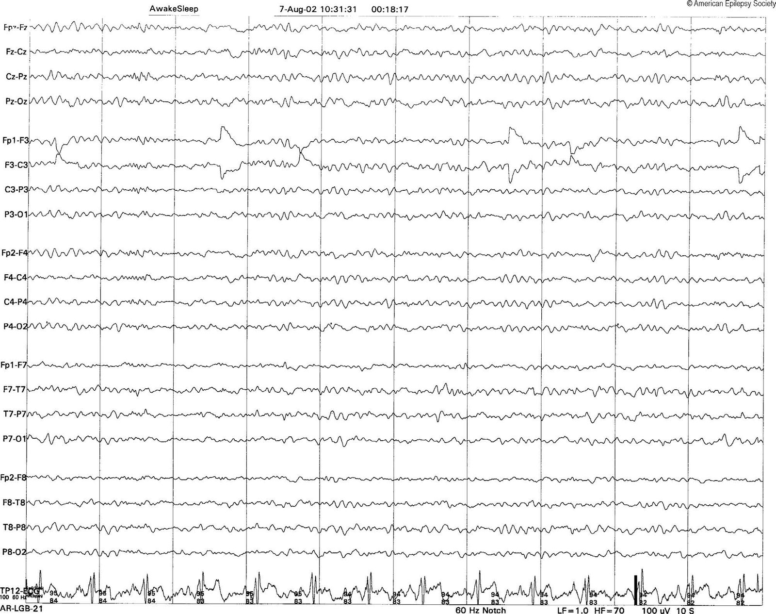 Electrode “pop” artifact at F3