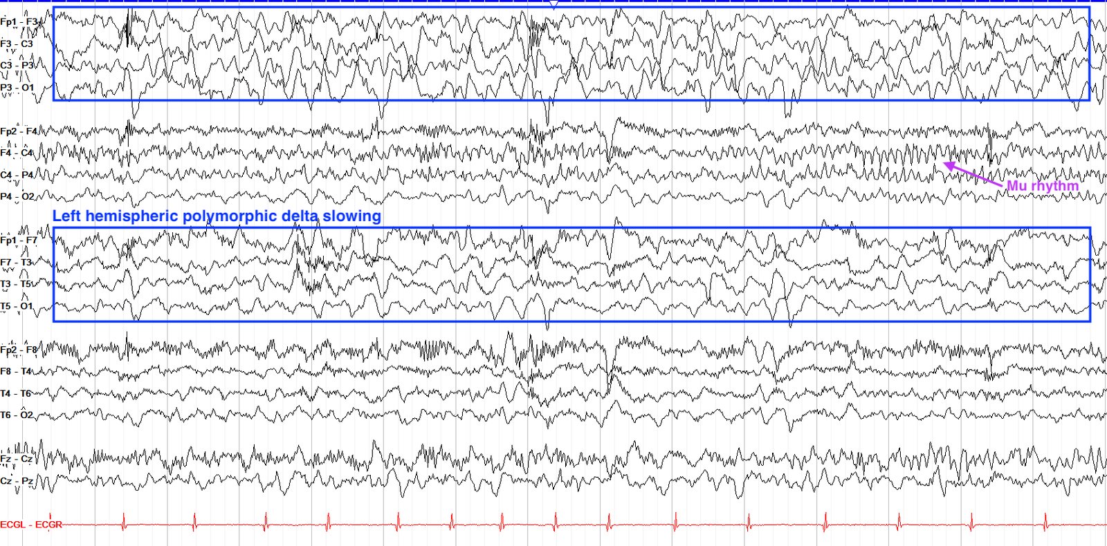 Left hemispheric polymorphic delta slowing