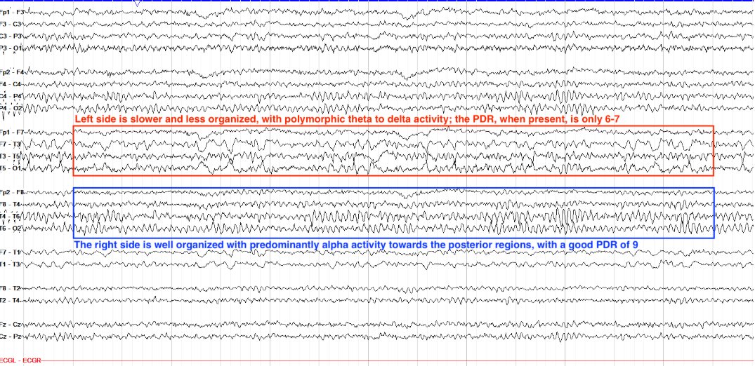 Focal slowing of the left hemisphere