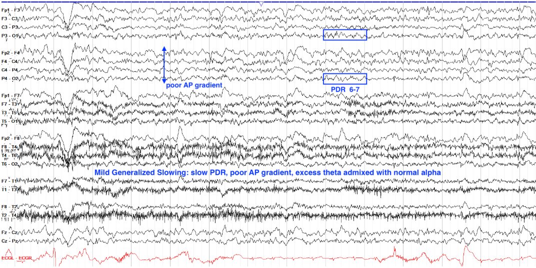 Mild generalized slowing