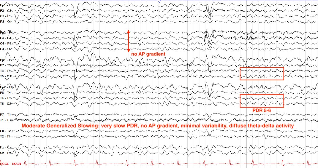 Moderate generalized slowing