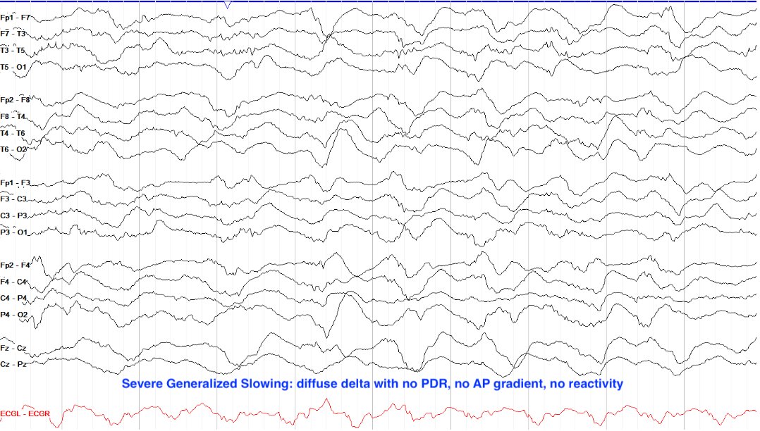 Severe generalized slowing