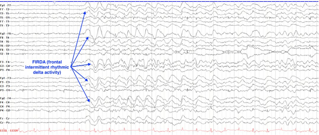 Frontal intermittent rhythmic delta activity (FIRDA)