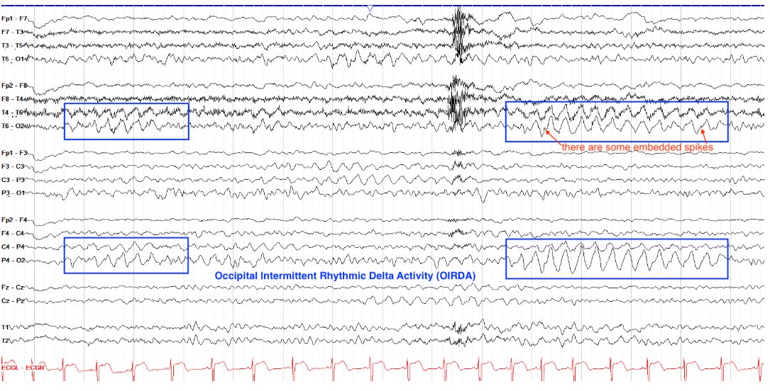 Occipital intermittent rhythmic delta activity (OIRDA)