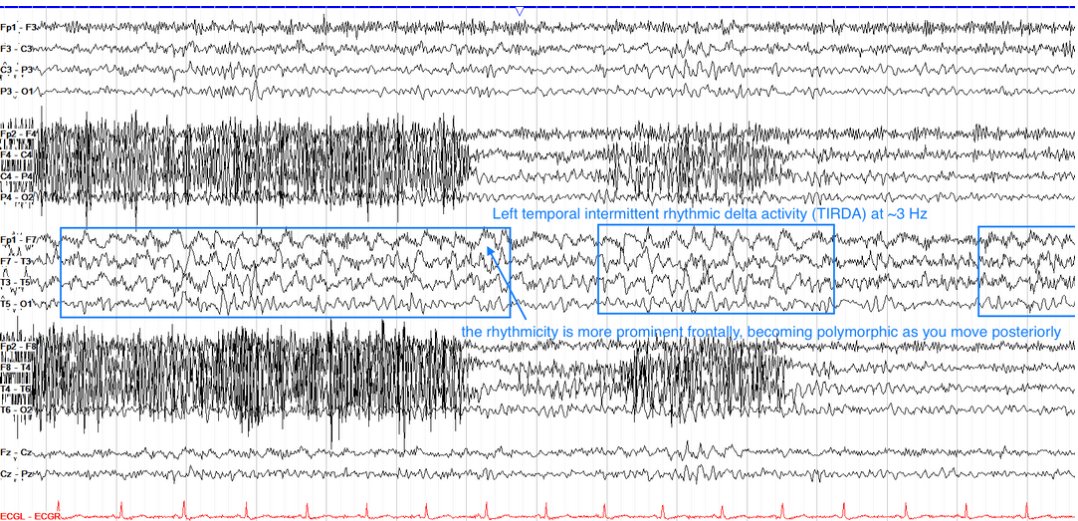 Temporal intermittent rhythmic delta activity (TIRDA)