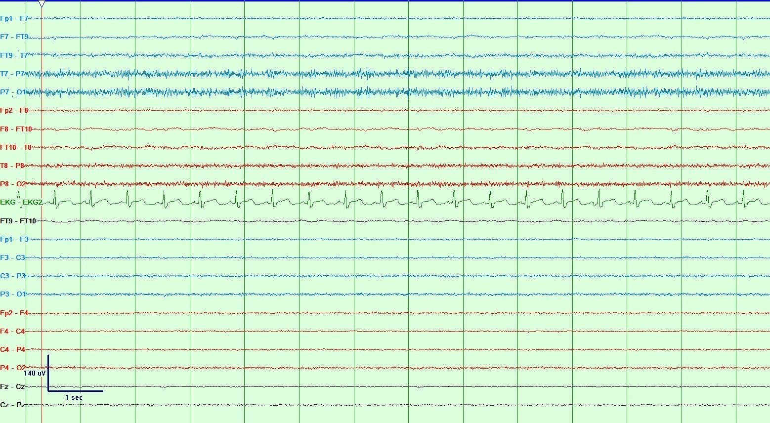 Generalized attenuation