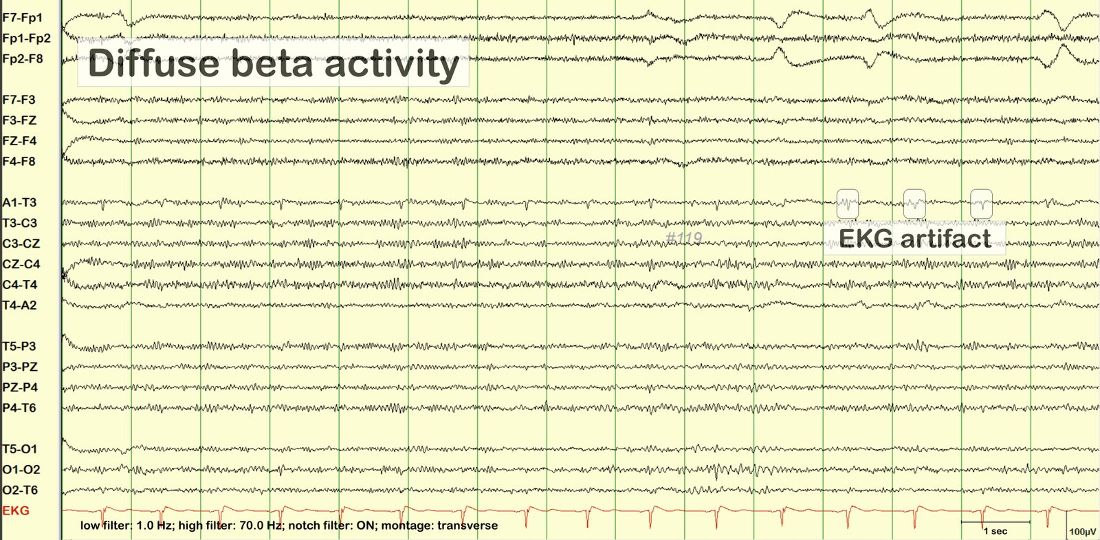 Diffuse beta activity with ECG artifact