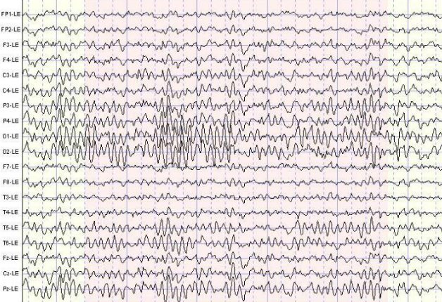 Alpha coma pattern (lecture example)